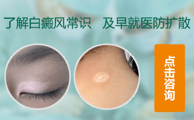 兒童白癜風，白癜風治療